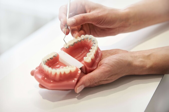 Modell eines 3D-Gebisses mit Zahnspange